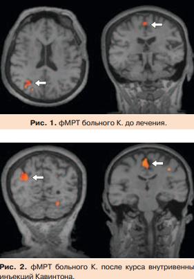 Современные подходы к лечению больных с хроническими сосудистыми заболеваниями головного мозга 