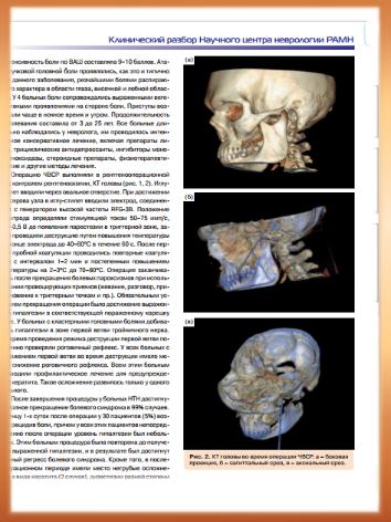 Чрескожная радиочастотная селективная ризотомия при невралгии тройничного нерва и кластерных головных болях 