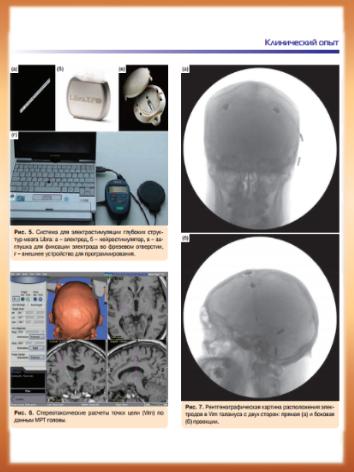 Хирургическое лечение эссенциального тремора: хроническая электростимуляция мозга с двусторонней имплантацией электродов в вентральное промежуточное ядро таламуса 