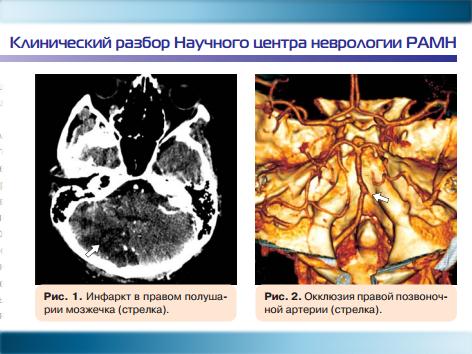 Ишемический инсульт у больного, страдающего железодефицитной анемией 