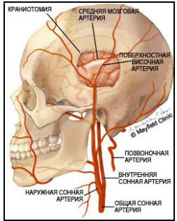 Шунтирование артерий головного мозга