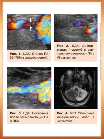 Алгоритм диагностики и принятия решения о хирургическом лечении вертебрально-базилярной недостаточности 