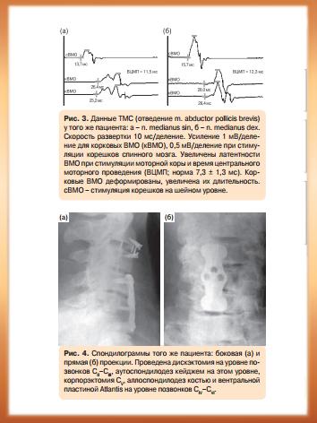 Случай хирургического лечения многоуровневой шейной миелопатии на фоне дегенеративной компрессии 